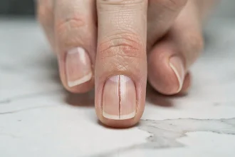 Gros plan d'un ongle fendu verticalement sur un doigt de femme posé sur marbre blanc, montrant clairement la fissure longitudinale
